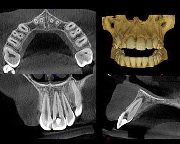 Diagnostyka stomatologiczna Katowice Obrazowanie tomografia 3D