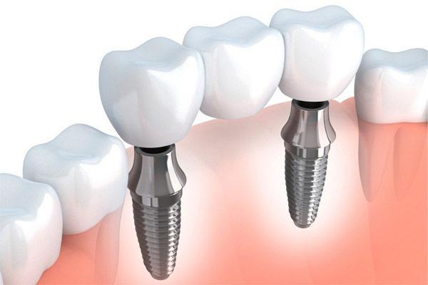 Implanty zębowe Katowice Korona zębowa na implantach
