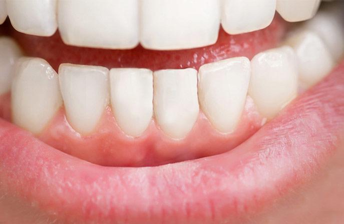 Implanty zębów Katowice Implant zęba po zakończonym leczeniu