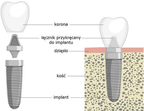 Implanty zębowe Katowice Zdjęcie poglądowe implantu
