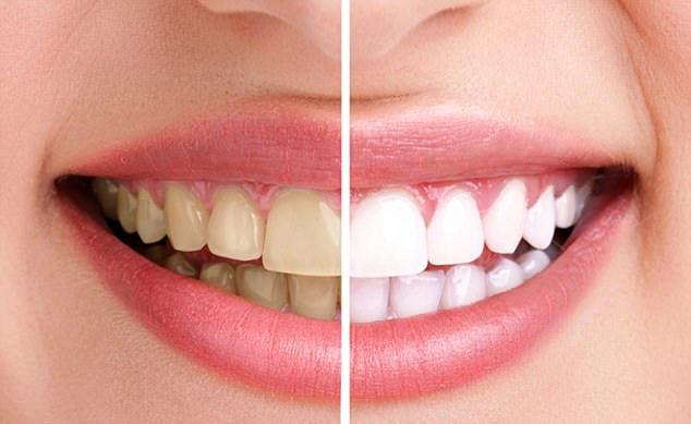 Wybielanie zębów Katowice Efekt wybielenia zębów1