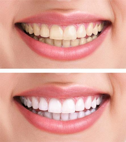 Wybielanie zębów Katowice Efekt wybielenia zębów2