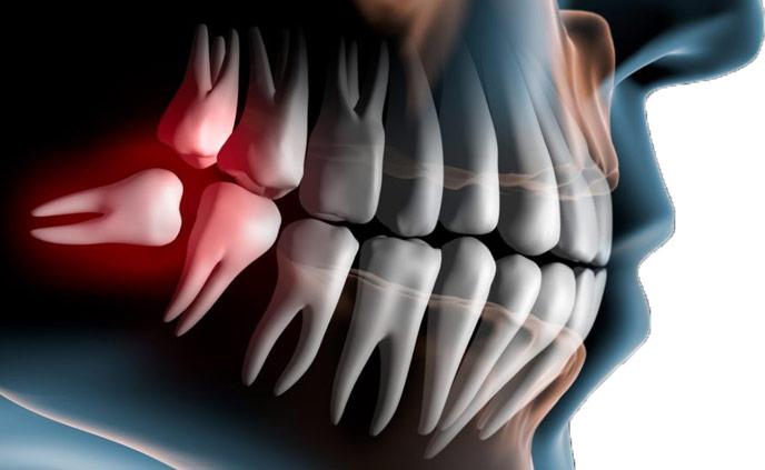 Chirurgia stomatologiczna Katowice Usuwanie ósemek - widok poglądowy