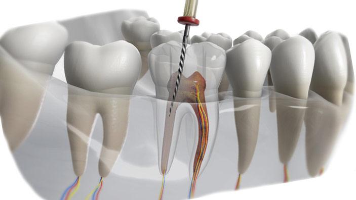 Model poglądowy endodoncji pod mikroskopem Katowice