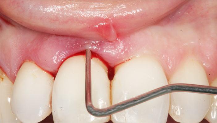 Chirurgia stomatologiczna Katowice Przetoka zębowa - Ropień zęba