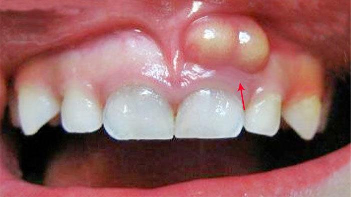 Chirurgia stomatologiczna Katowice Ropień zęba