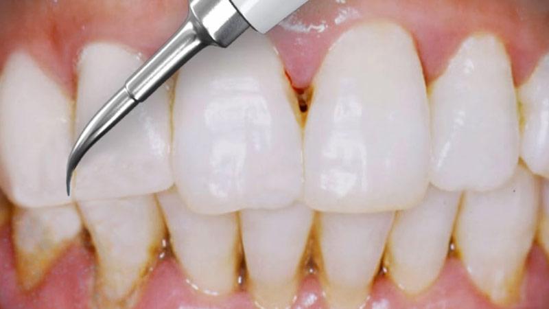 ​Profilaktyka stomatologiczna KatowiceSkaling zębów