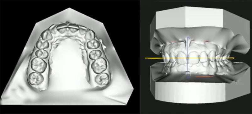 ​​Ortodonta Katowice Śląsk Skaner wewnątrzustny, modele cyfrowe 3D